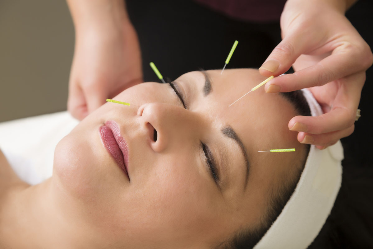 woman receiving facial acupuncture treatment